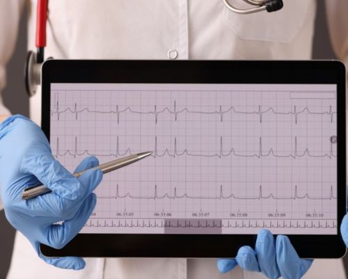 ECG
